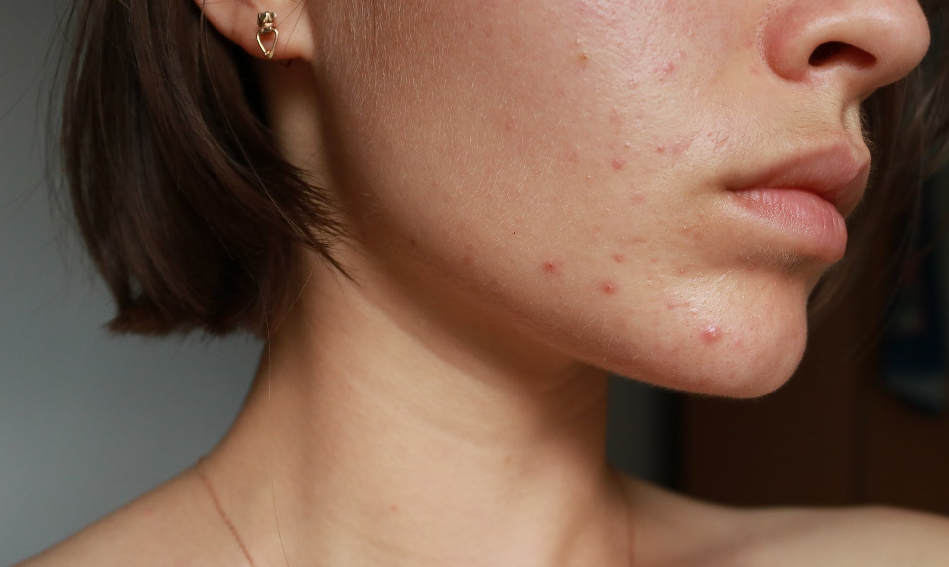 How Do I Know If My Acne Is Hormonal?